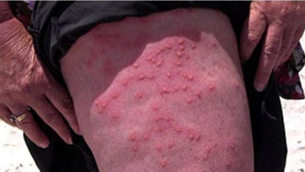 Mount Mauler' and sea lice blamed for spate of stings and itchy rashes